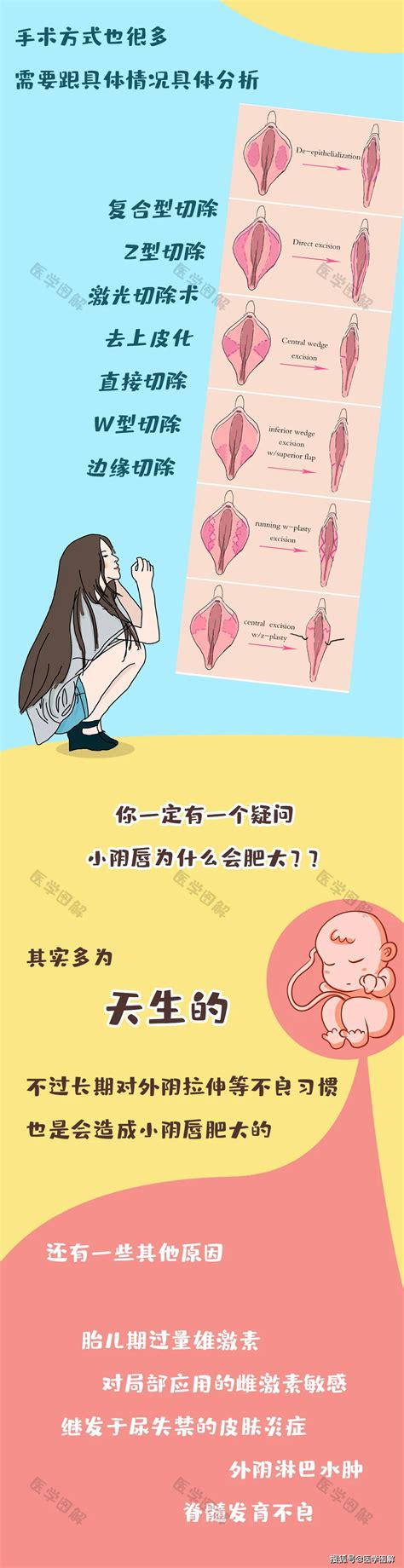 女性户型|女人阴部外形有几种